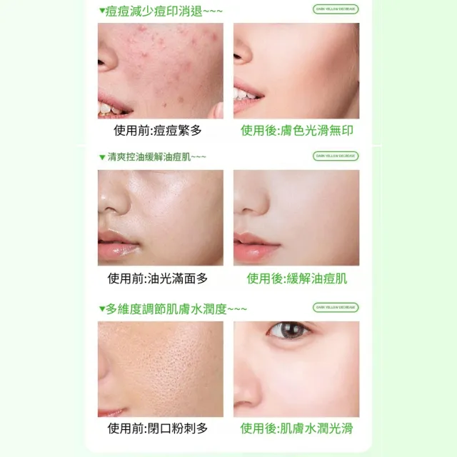 【iBloom】洛婭水楊酸果酸次拋精華液 1.5ml/支*30支(痘痘 痘印 痘坑 水楊酸 清爽控油)