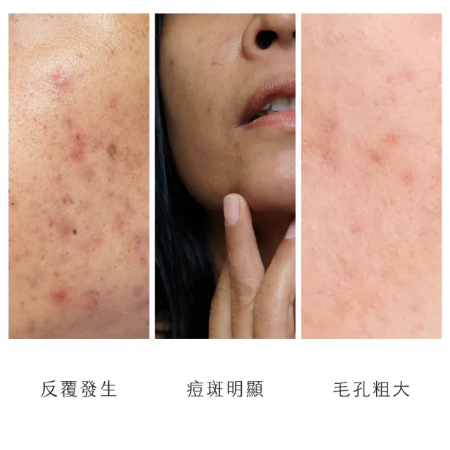 【阿皂屋】手工皂-痘痘皂推薦(痘痘肌-控油-漢方植萃-香皂-肥皂)