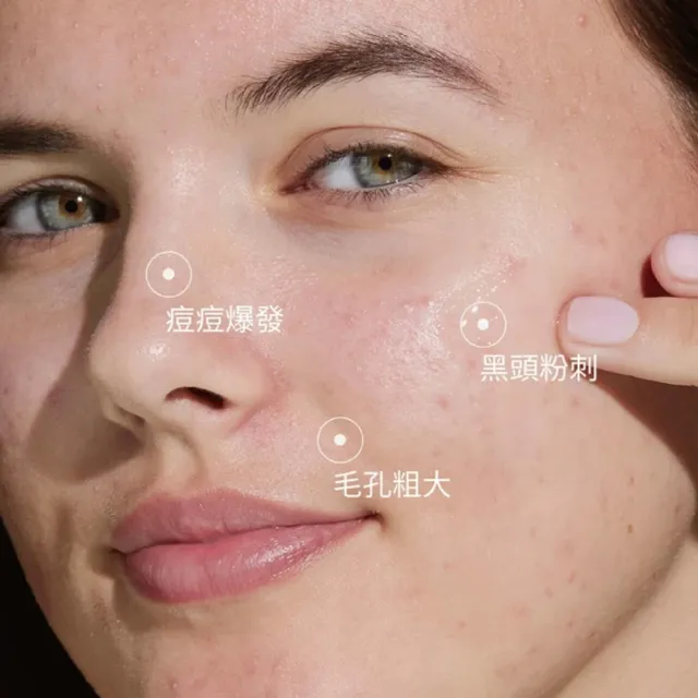 【CAUDALIE 歐緹麗】抗痘精華聯名組(淨化抗痘精華30ml+抗痘控油保濕霜40ml) (momo x KINGJUN美妝聯名袋)